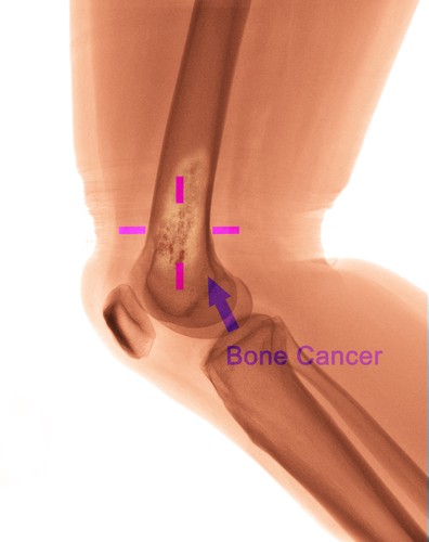 illustration of bone cancer